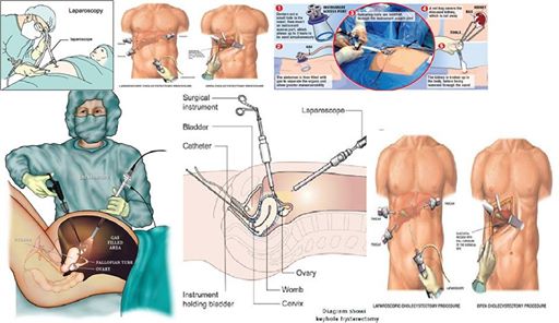 لاپاراسکوپی یا پهلوبین